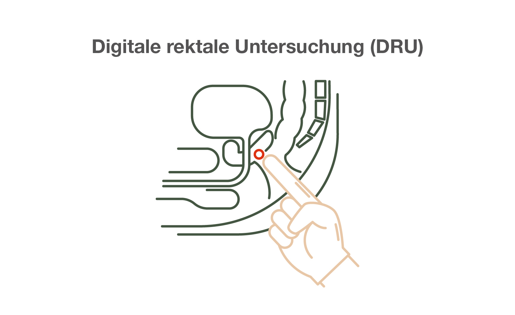 Digitale Rektale Untersuchung (DRU)
