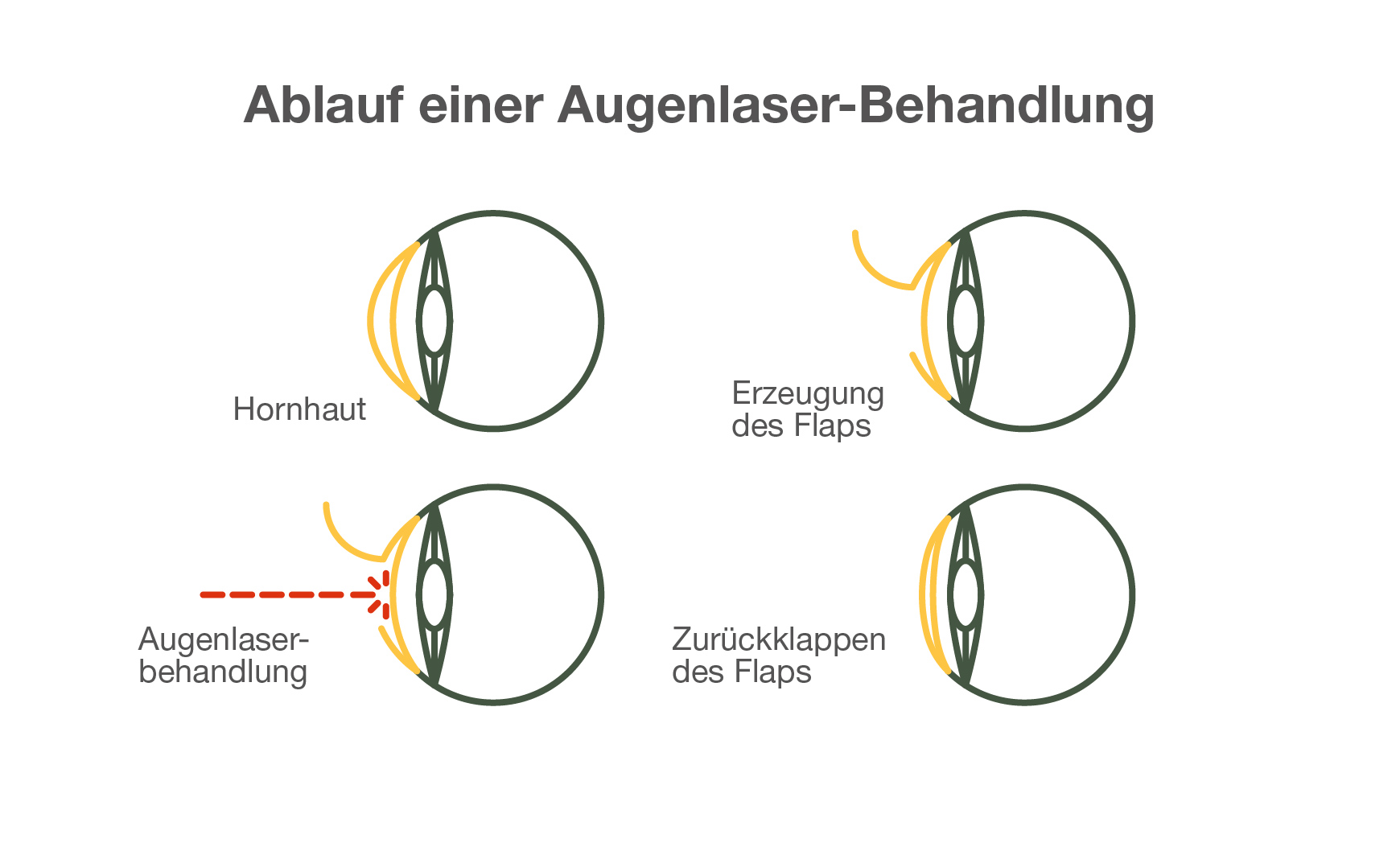 Ablauf einer Augenlaser-Behandlung