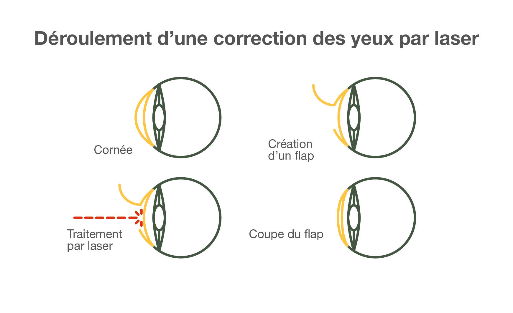 Déroulement d’une correction des yeux par laser