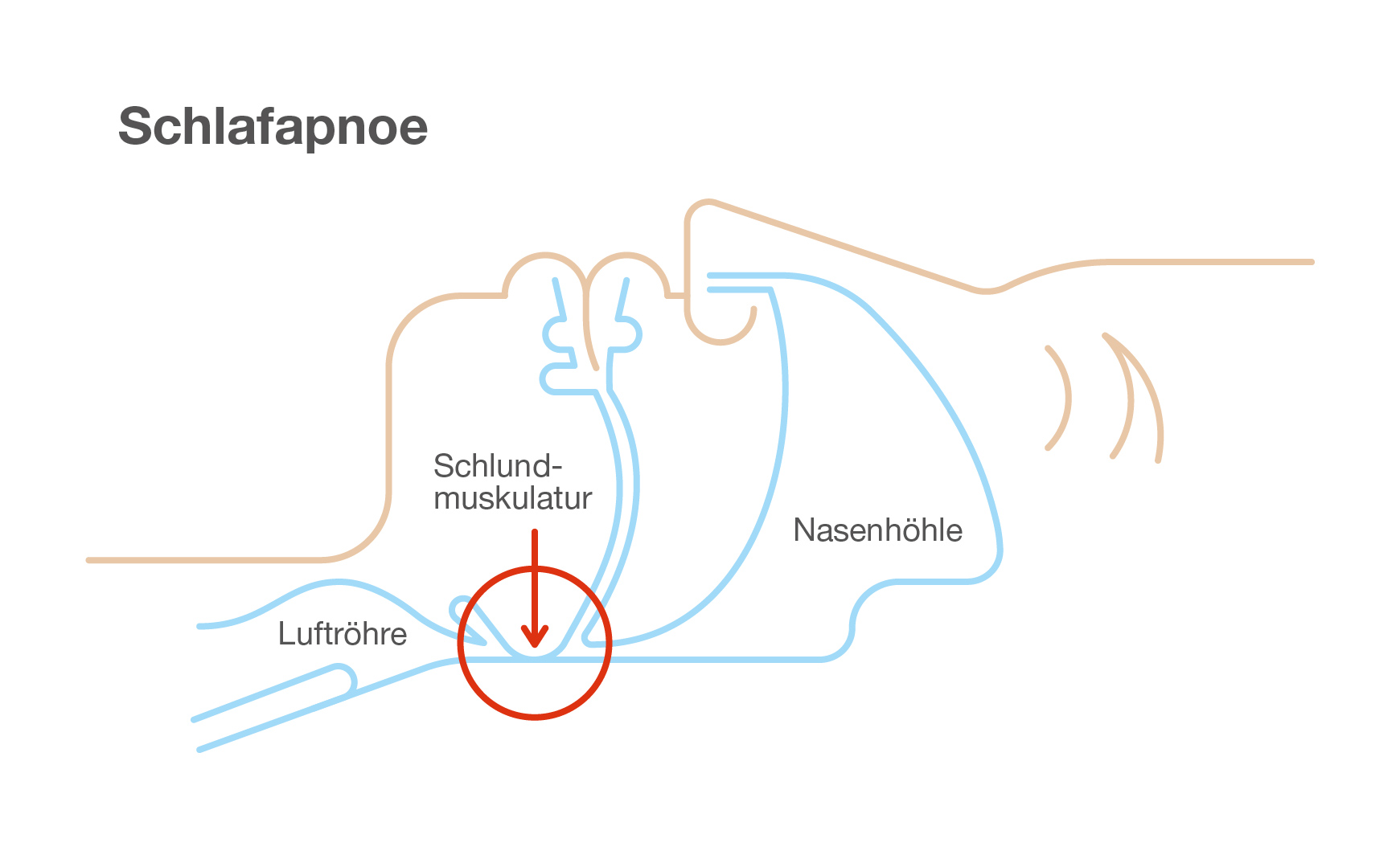 Schlafapnoe: Illustration