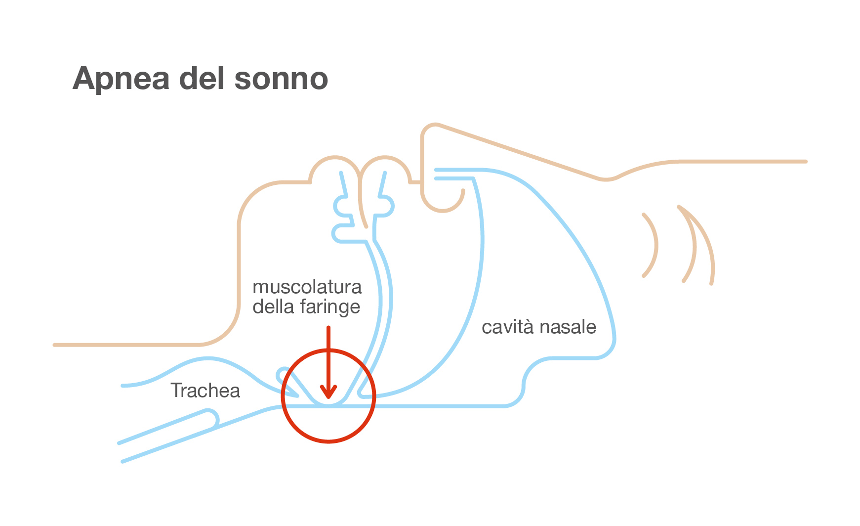 Schlafapnoe: Illustration