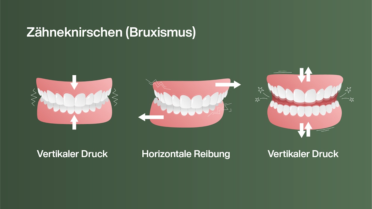 Illustration Zähneknirschen (Bruxismus)
