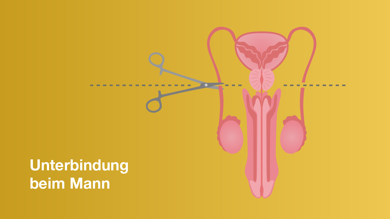 Darstellung einer Sterilisation beim Mann
