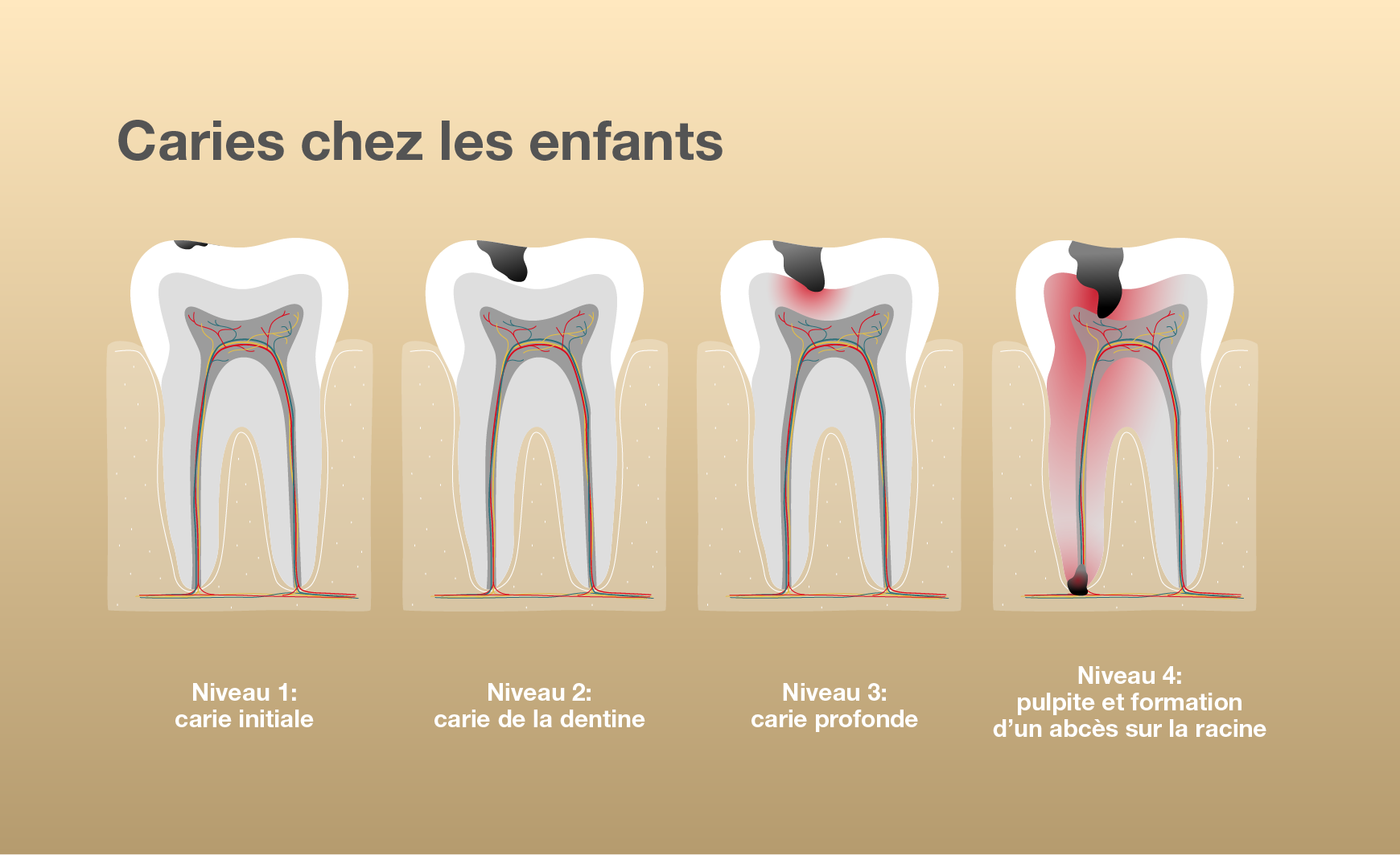 Reconnaître les caries chez les enfants