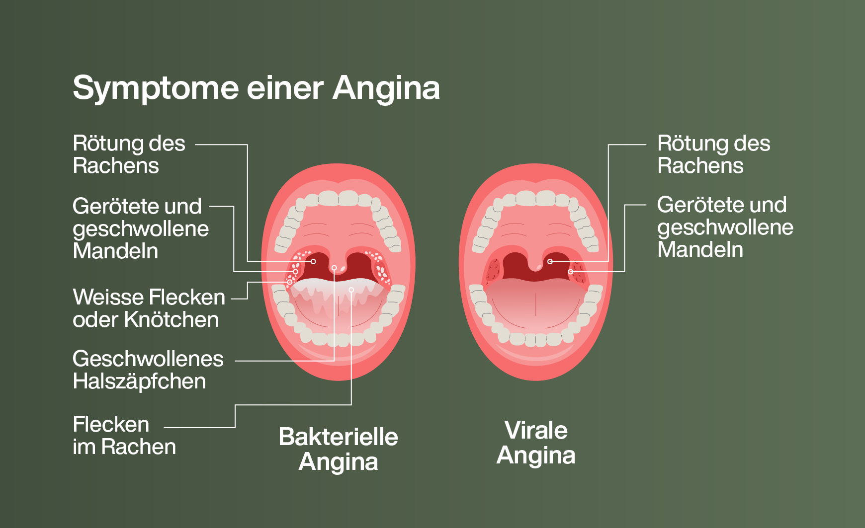 Symptome einer Angina: bakterielle und virale Angina