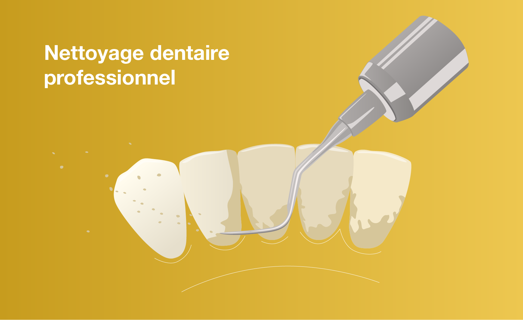 Nettoyage dentaire professionnel