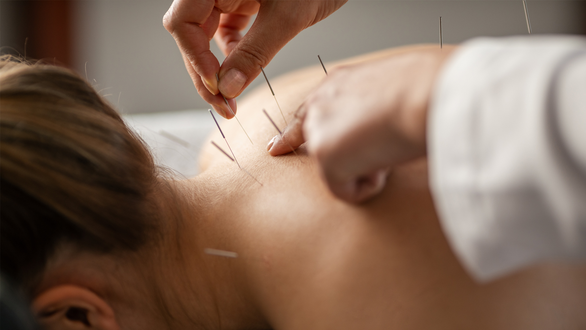 Séance d’acupuncture pour une femme dans un cabinet de médecine complémentaire