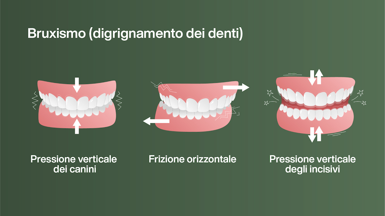 Immagine bruxismo e digrignamento dei denti