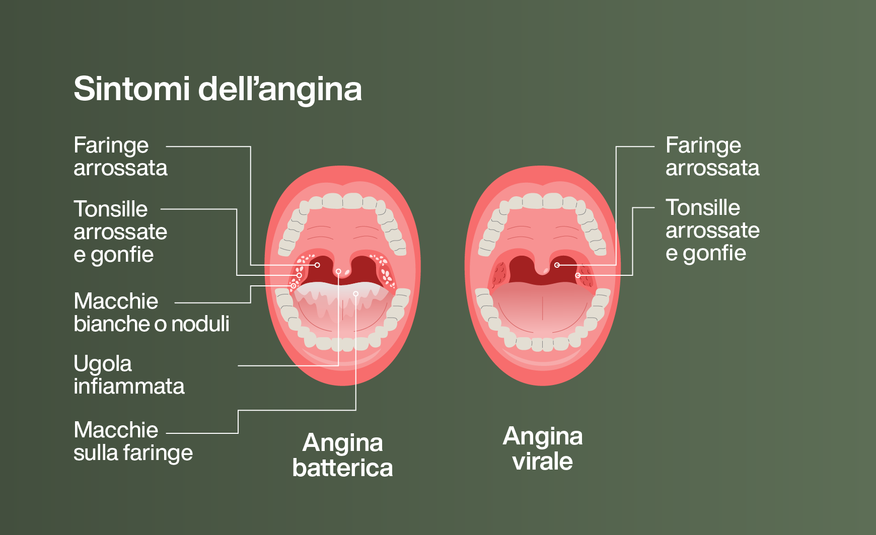 Sintomi dell’angina: angina batterica e virale