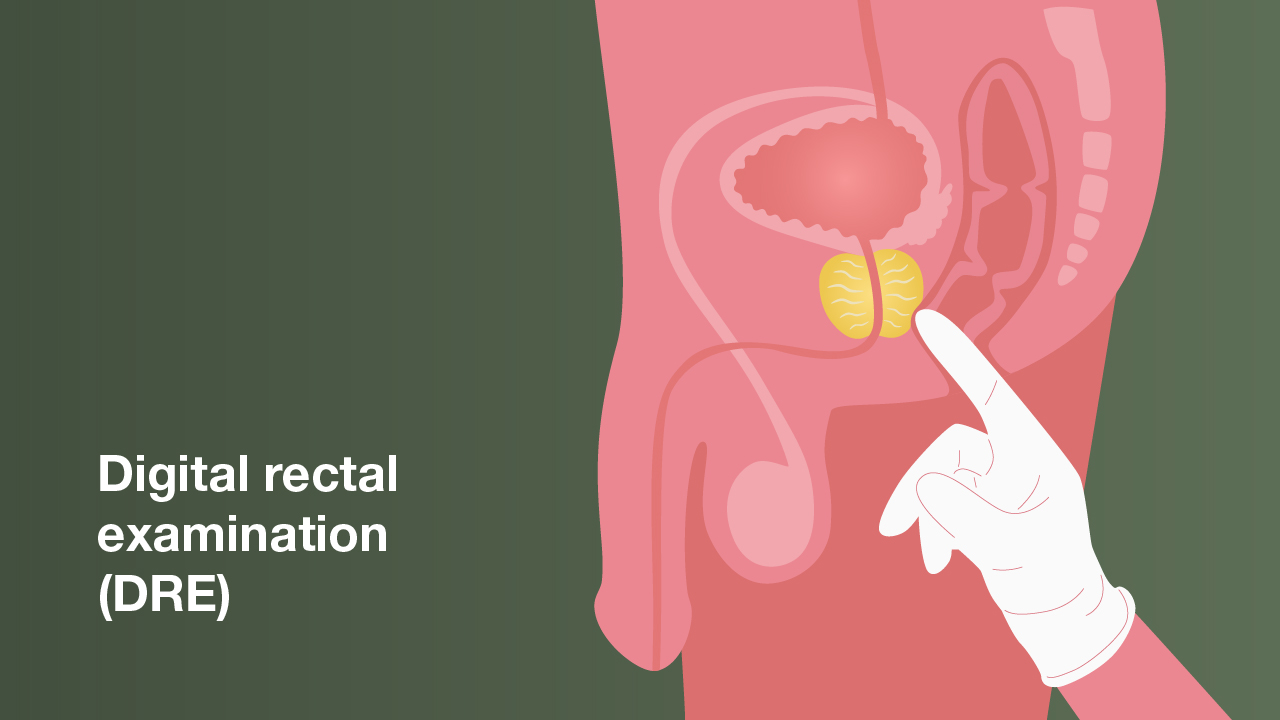 Digital rectal examination (DRE)