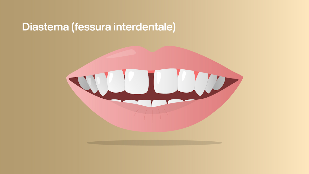 Chiudere un diastema: prima-dopo