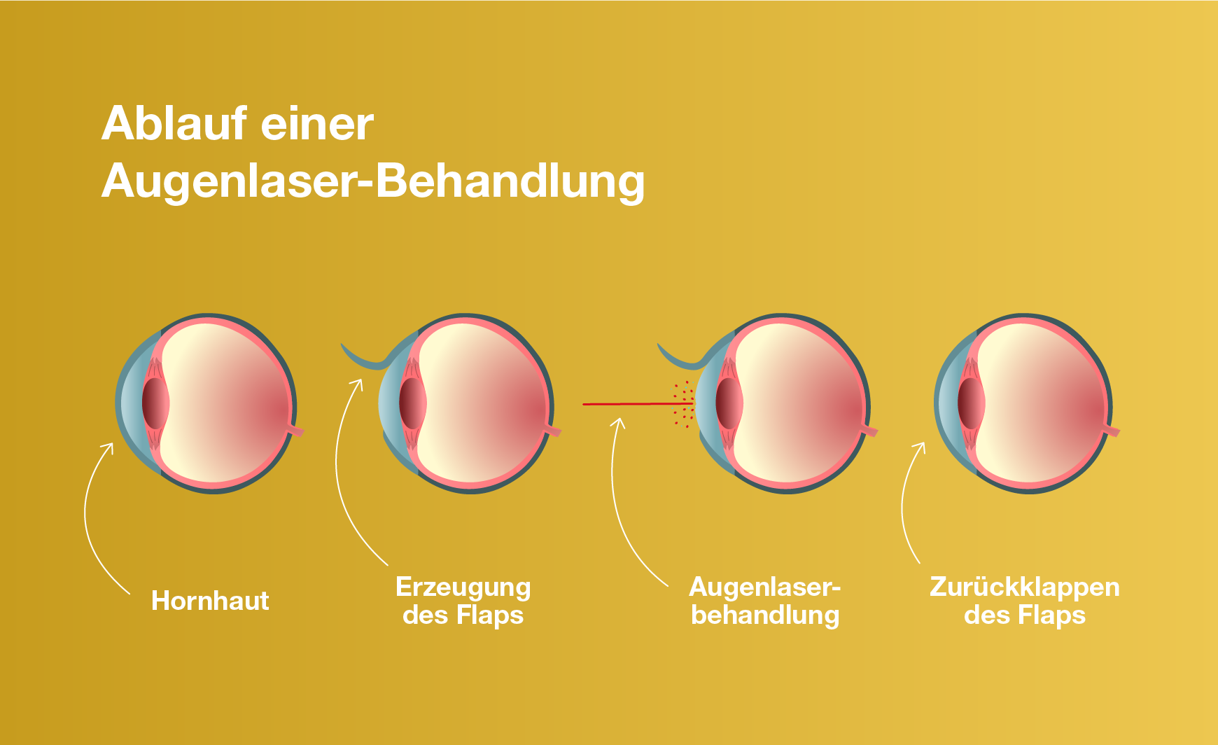 Ablauf einer Augenlaser-Behandlung