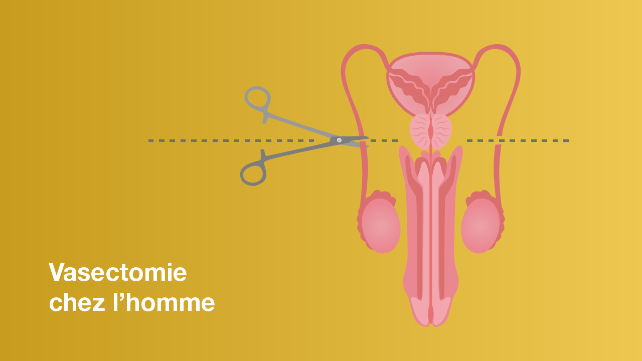 Représentation d'une vasectomie chez l'homme