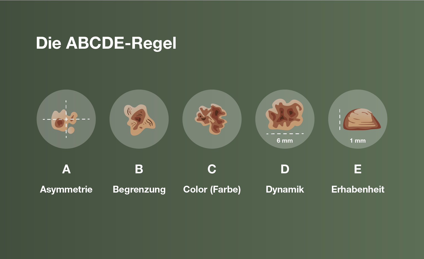Die ABCDE-Regel bei Hautkrebs