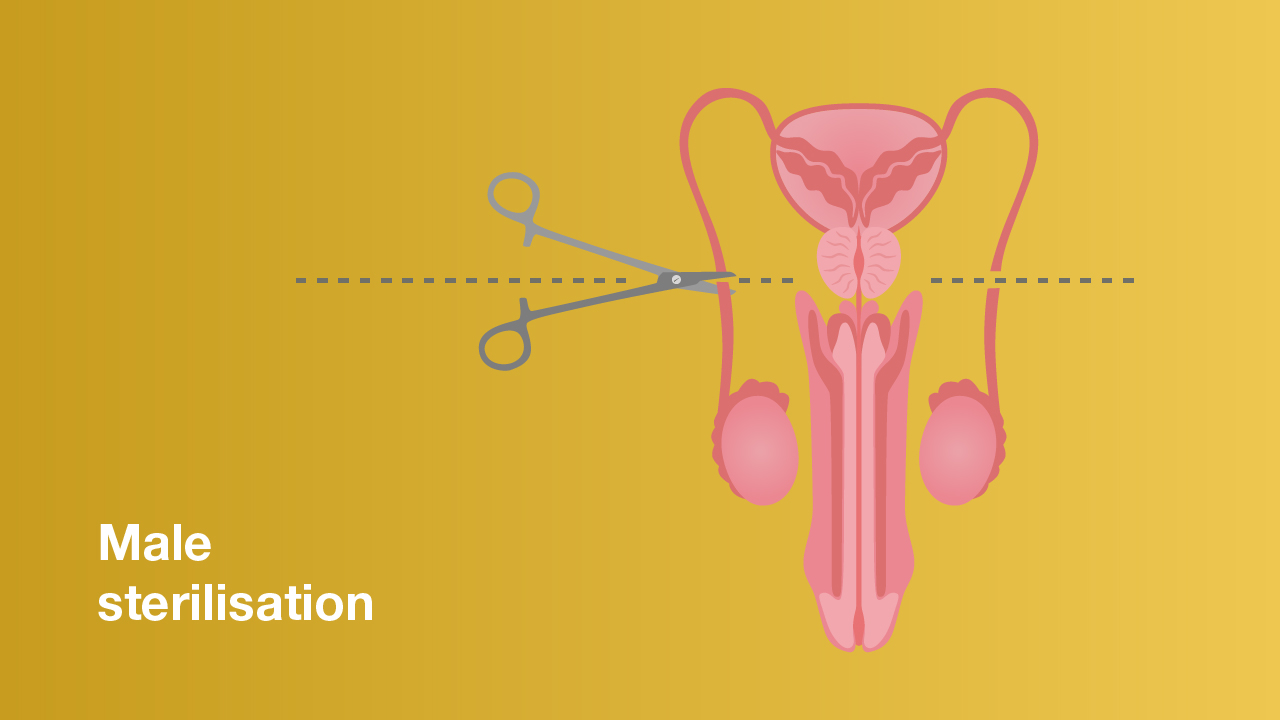 Illustration of a vasectomy