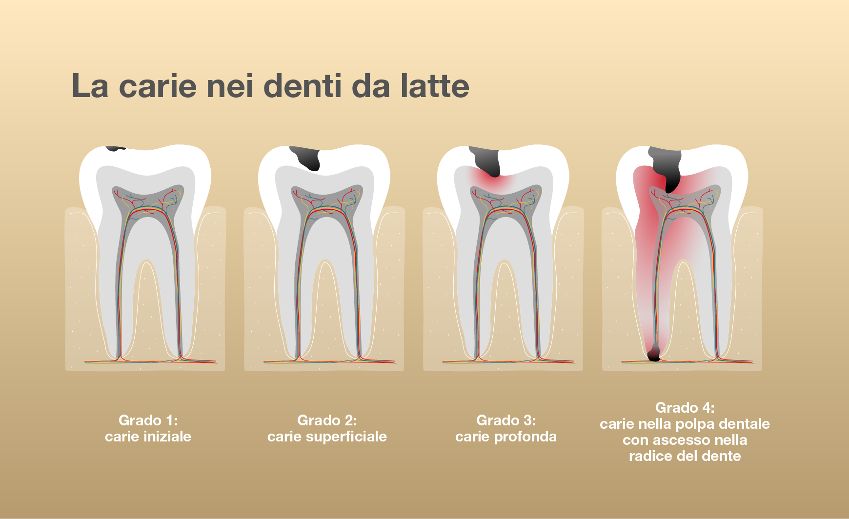 Riconoscere la carie nei denti dei bambini