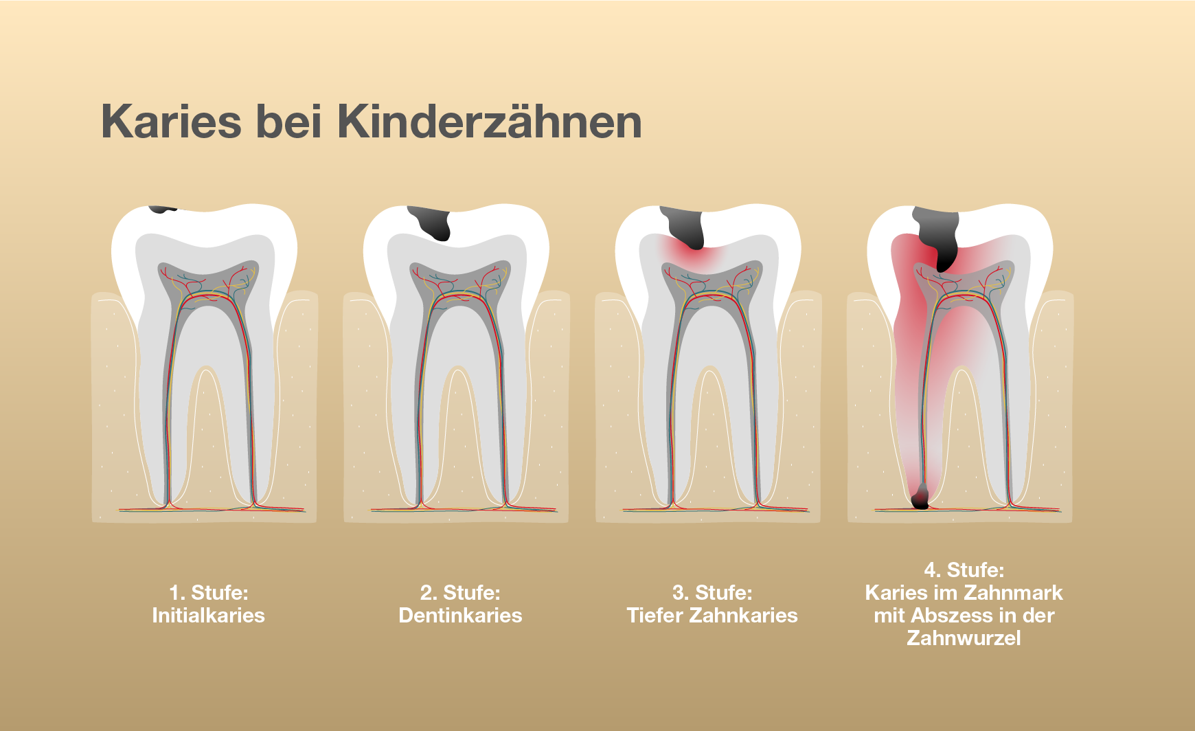 Karies bei Kinderzähnen erkennen