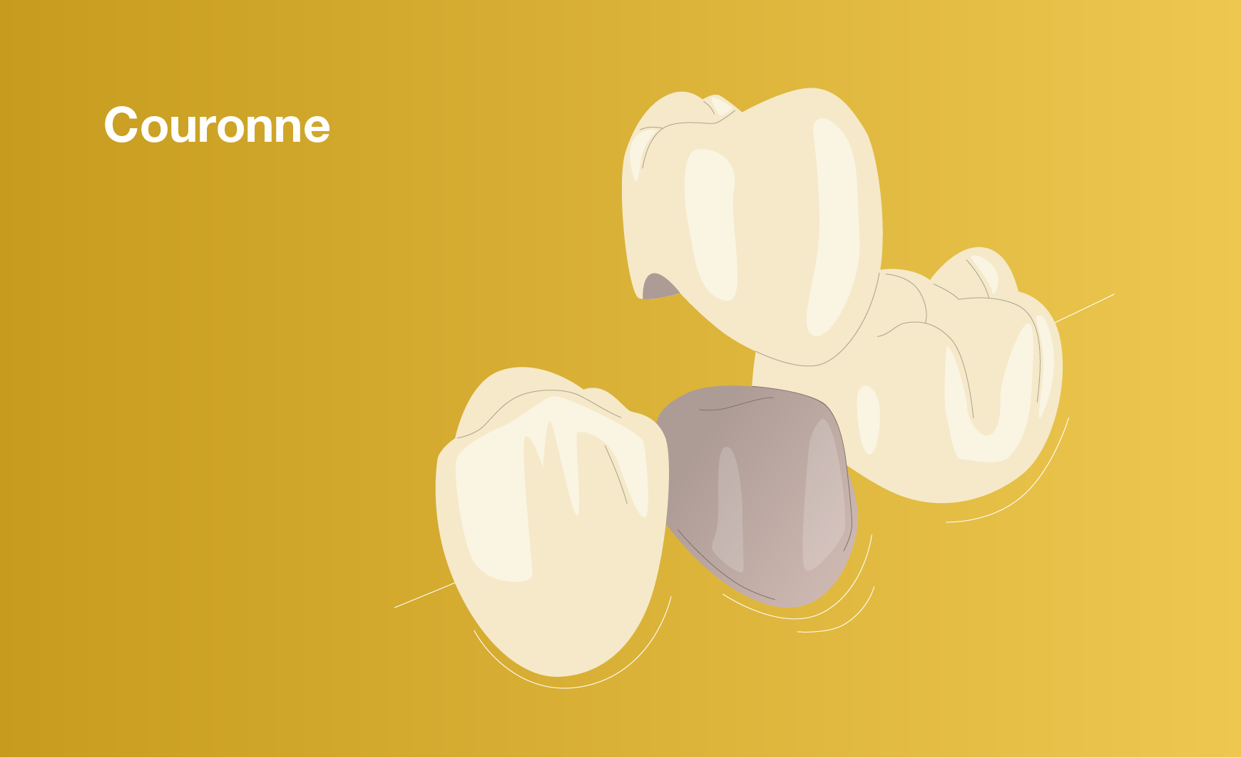 Couronne dentaire