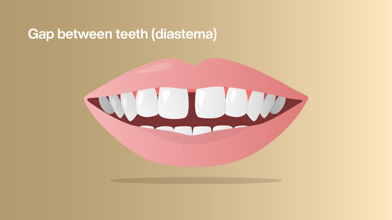Closing a tooth gap: before and after