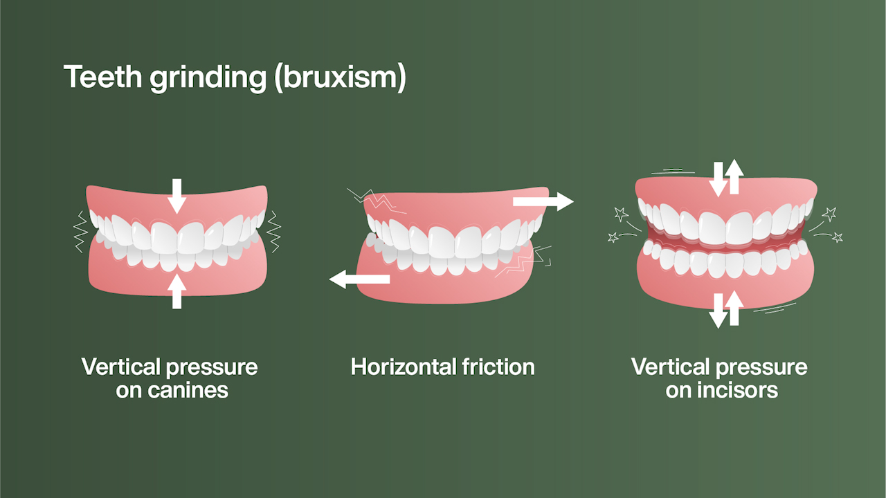 Teeth grinding (bruxism) illustration