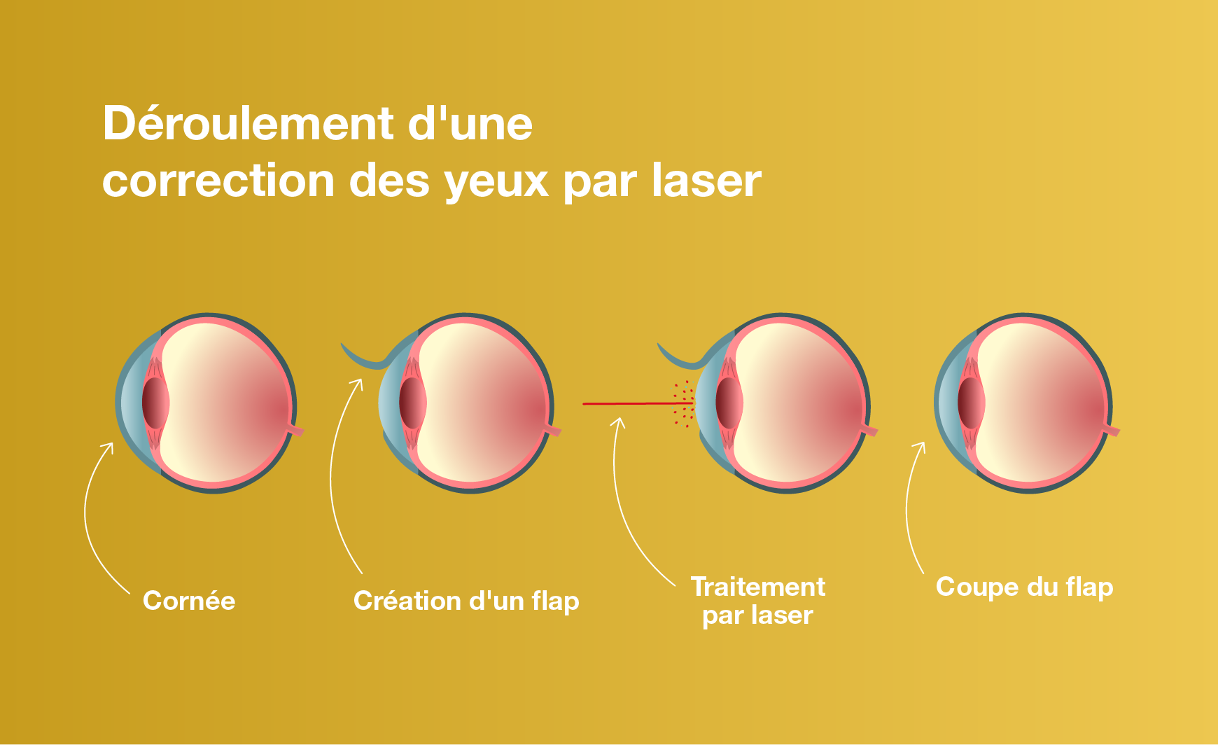 Déroulement d’une correction des yeux par laser