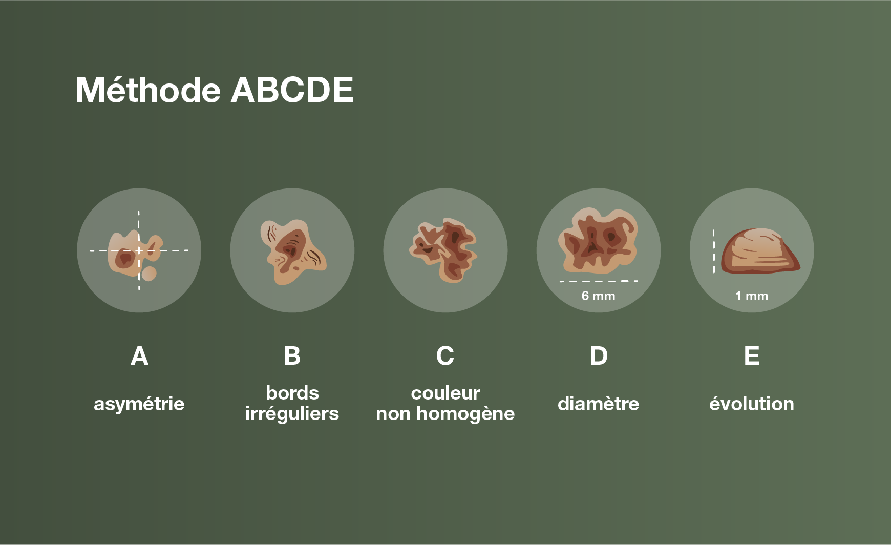 La règle ABCDE en cas de cancer de la peau