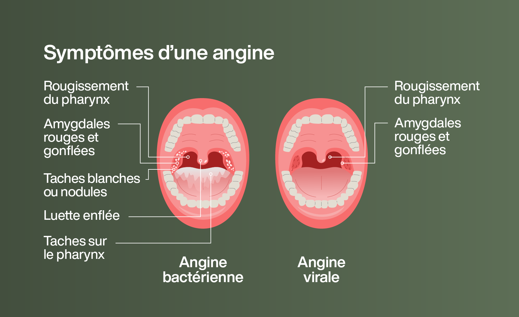 Symptômes des angines bactériennes et virales