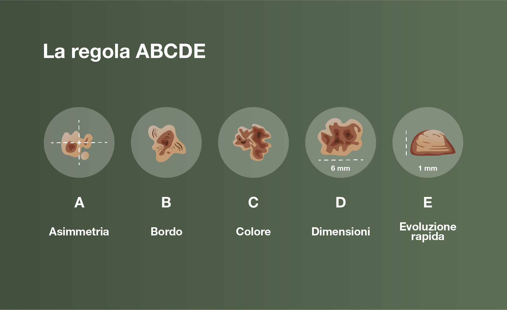 La regola ABCDE per il cancro della pelle