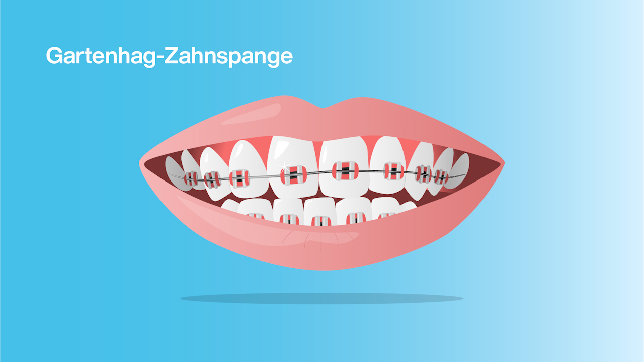 Gartenhag-Zahnspange (Brackets)